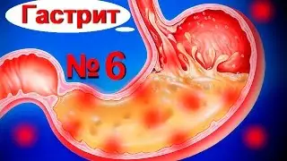 Болит желудок? Лечение гастрита - Боли при гастрите №6