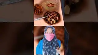 Asmr Perawatan Luka infeksi gigitan lebah, belatung dan ulat |Mv 