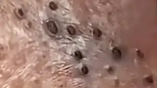 Blackheads & Whiteheads Satisfying Removal @0164