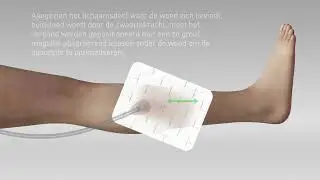 Avance Solo - Applicatie op wond