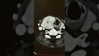 Узловой зоб на КТ.
