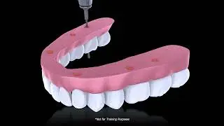 Introducing Smart Denture Conversions