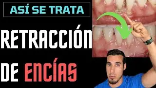RECEDING GUMS - GRAFT treatment before and after