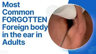 Most Common FORGOTTEN Foreign body in ear in Adults