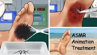 ASMR Remove sea urchin spines embedded in the soles of feet