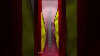 Coronary Artery Stent Placement (Animation)