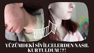 CİLDİME NE OLDU !?! SİVİLCELERDEN NASIL KURTULDUM !?!