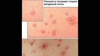 Chickenpox how to quickly cure chickenpox