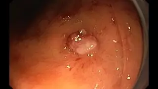 Endoclipping of Dieulafoy's hemorrhage