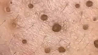 Blackheads & Whiteheads Satisfying Removal @0116