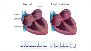 What is Atrial Fibrillation?