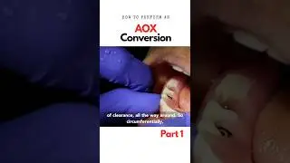 How to do an AOX conversion- Part 1 all on 4 #allonx #dentalimplants