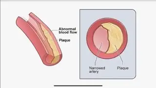 Diabetes and Chest Pain (Multi-Video Stream)