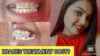 BRACES TREATMENT COST?/ब्रेसेस ट्रिटमेंट करवाने मे कितना खर्चा लगता है? #braces #bracescost #youtube
