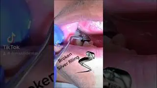 Silver Fillings , Amalgam fillings