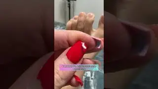СКРУЧЕННЫЙ НОГОТЬ! ПОЧЕМУ? ТАМПОНАДА ВРОСШЕГО НОГТЯ! CURLED NAIL!WHY? TAMPONADE OF AN INGRONED NAIL!