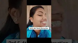 Braces Journey Result 100% #braces #bracesjourney #shorts #trending #bracestransformation #bracket