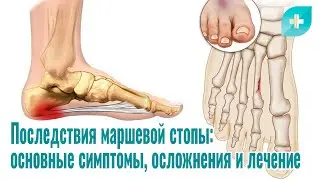 Последствия маршевой стопы: основные симптомы, осложнения и лечение