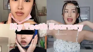 HERE’S MY TEETH JOURNEY… | wisdom teeth surgery, extractions, deep cleaning, braces process