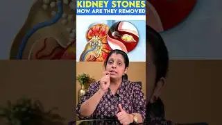 Kidney stones - How are they removed