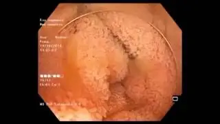 Water jet ileoscopy. Подводная илеоскопия