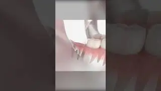 Wisdom Tooth Extraction: ASMR