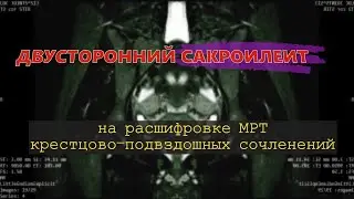 Двусторонний САКРОИЛЕИТ и признаки БОЛЕЗНИ БЕХТЕРЕВА у женщин на РАСШИФРОВКЕ МРТ КПС (второе мнение)