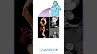 Diagnostics on Demand: Aortic dissection