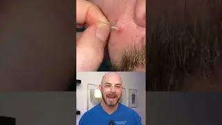 Doctor reacts to slimy pimple patch removal! 