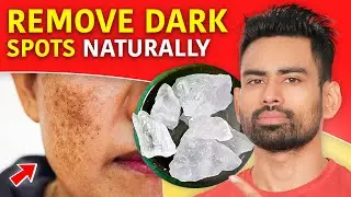 How to Remove Dark Spots and Get Clear Skin? (Pigmentation, Dark Underarms, Acne scars & more)