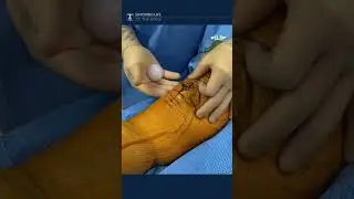 Kneecap [patella] button loosens after total 