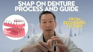 Snap on denture steps