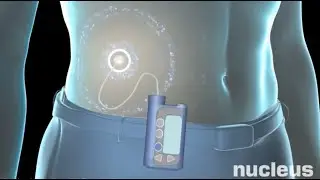 Insulin Pump