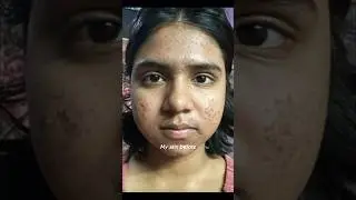 How I cleared my acne prone skin skin in 30 days 