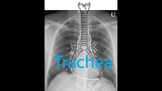 Chest x ray - Part 2 -Trachea -- Normal Anatomy