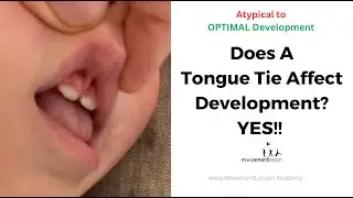 Atypical Development Baby Does Tongue Tie or Lip Tie Affect Development? YES!