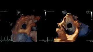 Vena cava superior (TTE vs. TOE)