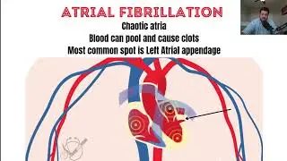 What Causes Stroke in Atrial Fibrillation (Afib)?