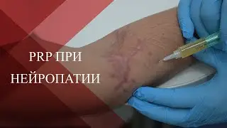 💉PRP терапия при  посттравматической нейропатии в следствии травм и ранений