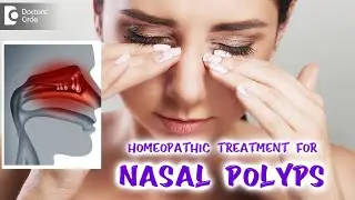 NASAL POLYPS | Best Homeopathic Treatment - Dr. V. Bhagyalakshmi | Doctors Circle