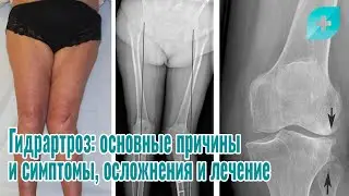 Гидрартроз: основные причины и симптомы, осложнения и лечение