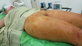 Plastic Surgery #20   A simple Case of Liposuction for girl