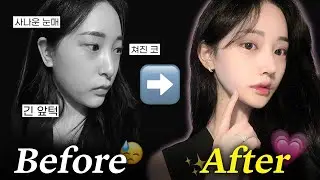 이웃집 흰둥이상에서 노윤서 닮은 고양이상으로!😺 | 눈재+코재+미니브이라인 (수술 당일~ 1개월 리얼 후기)