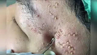 pimple popping - blackhead removal - blackheads removal - acne treatment - skin care