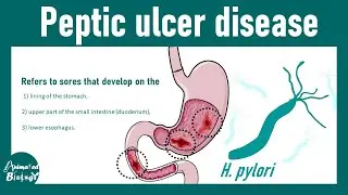 Peptic ulcer disease | Cause of gastric and duodenal ulcers | USMLE step 1