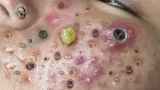 pimple popping - blackhead removal