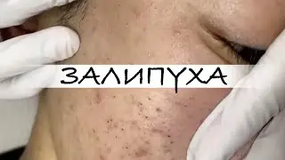 ПРЫЩИ 😍 ПРЫЩИ ВЫДАВЛИВАНИЕ 😍 ПОДБОРКА ВЫДАВЛИВАНИЕ ПРЫЩЕЙ 