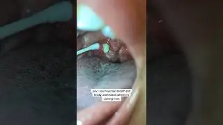 How You Are Removing Tonsil Stones The WRONG Way! 😳🪥