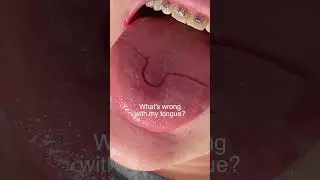 What's Wrong With My Tongue?!?! 👅