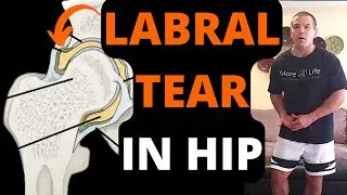 Labral Tear In Hip - Symptoms, Treatment, & Exercises For Labral Tear In Hip